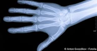 Kahnbeinbruch Ursachen Symptome Behandlung Netdoktor