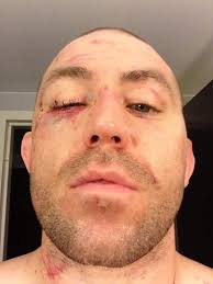 Alan Belcher received 8 stitches to his eyelid, here's the pic.