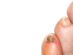 The condition is a type of mucormycosis, which is a fungus infection causing a nasal infection. Toenail Discoloration Treatments For Yellow Purple Black Nails