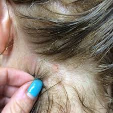 Possible Scalp Ringworm Ringworm Healthy Hair Rejuvenation Ringworm of the scalp, also known as tinea capitis, is a fungal infection. possible scalp ringworm ringworm