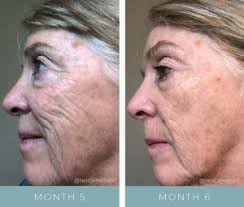 Acne Scarring: Nanotechnology Microneedling NeoGenesis