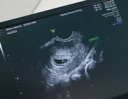 Image result for First Trimester Ultrasound