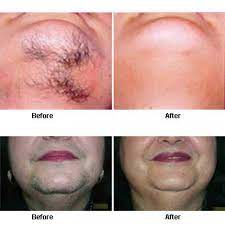Licensed professionals administer small electrical currents designed to permanently remove hair without damaging the surrounding skin. Hair Removal Before And After