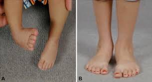 Check spelling or type a new query. The 2017 Abjs Nicolas Andry Award Advancing Personalized Medicine For Clubfoot Through Translational Research Springerlink