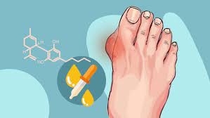Discuss cbd with your doctor before you take it to make sure it's safe for you.17 x trustworthy source mayo clinic. Cbd Oil For Gout Help For Inflammation And Pain