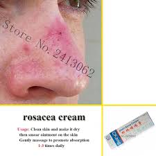 Antibiotics (erythromycin, clindamycin, tetracyclin), metronidazol, azelaic acid, and the retinoid adapalene have been shown to be effective in well controlled randomized studies. Rosacea Cream Red Nose Ointment Remove Blackhead Acne Cream Skin Care Herbal Anti Acne And Mite Acne Rosacea Treat Shrink Pores Aliexpress