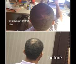 This ogx shampoo contains vitamin e, which is a hair vitamin that helps to prevent damage. Biotin Shampoo Hair Loss Expert Opinion