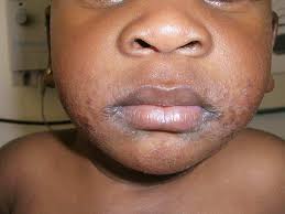 Image result for ekzema face