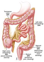 However, anyone experiencing new symptoms may wish to visit a doctor for a diagnosis. Colon Cancer Despite A Late Diagnosis Colorectal Cancer