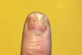 Nails separating from the nail bed is a telltale sign that you need to take a step back from vigorously cleaning under the nail. Psoriasis In The Fingernails And Toenails
