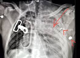 Join facebook to connect with guns gsw and others you may know. Nbrowardradiologists On Twitter Chest Xray Shows Bullet Fragments Arrowheads And Lung Bruise Arrow Contusion In A Gunshot Victim Radiologist Radiology Pain Injury Gun Gsw Trauma Https T Co Mhup4dgira