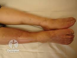 Image result for Lipodermatosclerosis