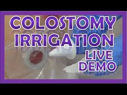 Colostomy Irrigation Procedure Care Ostomy Enema Nursing Stoma Cleaning