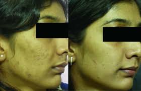 We did not find results for: Chemical Peels At Home Explained 13 Studies Everything You Need To Know