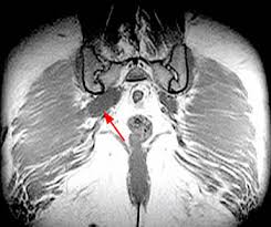 The muscles of the pelvis form its floor. Piriformis Syndrome Radsource