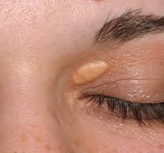 Image result for xantelasma