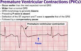 Typical ecg findings of pvcs. Rosh Review Nursing Mnemonics Icu Nursing Surgical Nursing