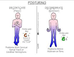 Posturing Medical Surgical Nursing Surgical Nursing Nursing School