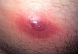 It is sometimes called a trichilemmal cyst although most people confuse it with a pilonidal cyst (which is a cyst although you can do it if you know how to pop an ingrown hair cyst on your own and applying medication to prevent infection, it is highly discouraged. Ingrown Hair Best Way To Pop Ingrown Hair