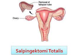 Pernah mengandung luar rahim sebelum ini. Info Lengkap Mengenai Mengandung Luar Rahim Berserta Doa