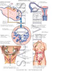 Cancer starts when cells in the body begin to grow out of control. Epithelial Ovarian Cancer