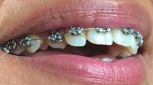 I was just curious as to how long traditional braces (or preferably invisalign if my gap is not too big for the system) would take. Braces Time Lapse Impacted Canine Before And After Youtube