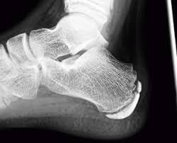 Image result for Calcaneal Apophysitis