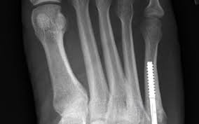 However, due to limitations of supply and morbidity associated with autograft conclusion: Fifth Metatarsal Or Jones Fracture