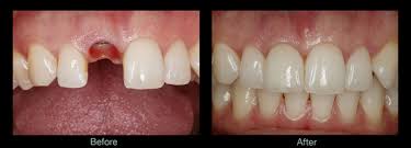 Check spelling or type a new query. Full Dental Implants Cedar Park Reveal Dental