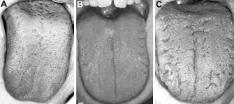 Image result for Fissured tongue