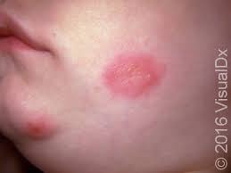 Image result for sores on the head in children