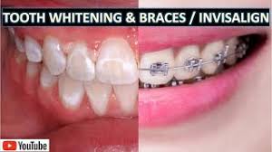 Free delivery offer excludes same day delivery. Your Question Can Braces Stains Be Removed