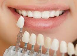 Cosmetic Dentistry Covina Porcelain Veneers Teeth Whitening