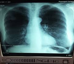 Cancerul pulmonar constituie una dintre cele mai frecvent intalnite si grave tipuri de cancer. Fumatul Si Cancerul