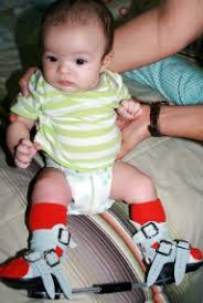 Pin By Voeten Centraal On Steps Clubfoot Favourites Club Foot Baby Club Foot Baby