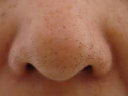 I must have large pores, but how can i hello, blackhead is a blackish bump or plug on the skin and is a type of acne vulgaris. Black Head Buddy Kinmay