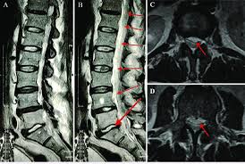 Understanding Retrolisthesis Lumbar: A Comprehensive Guide