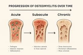 Image result for Osteomyelitis