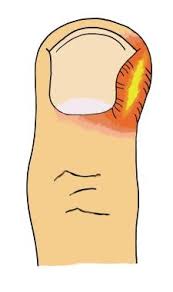 Image result for paronychium