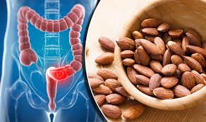colon cancer ile ilgili görsel sonucu