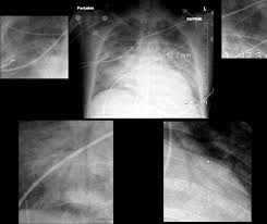 Image result for Air Bronchogram