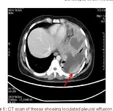 Most pleural effusions with large numbers of polymorphs are however, ct can help distinguish between a pleural effusion and a pleural empyema (see pleural strange or atypical configurations of pleural fluid can be due to either adhesions (i.e. Figure 1 From Primary Pleural Synovial Sarcoma A Rare Cause Of Hemorrhagic Pleural Effusion In A Young Adult Semantic Scholar