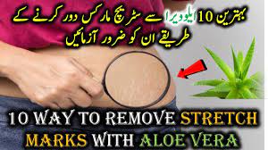 10 Way To Remove Stretch Marks With Aloe Vera In Urdu Hindi Stretch Ma Stretch Marks Aloe Vera Beauty Products Natural Beauty Remedies