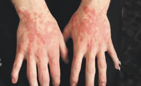 Image result for Auspitz Sign