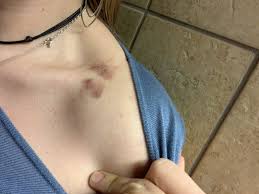 Love Bites Hickeys Love Bites Tattoos
