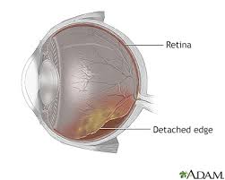 Retinal detachment repair is eye surgery to place a retina back into its normal position. Retinal Detachment Repair Information Mount Sinai New York