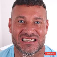 UK Resident's Smooth Dental Transformation Experience at Oz Clinic