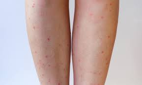 Weisse flecken entstehen und sich das gewebe immer mehr verhärtet. Rote Flecken Am Bein Ursachen Und Behandlung Praxisvita