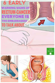 If you notice blood in your stool, this could be a telltale sign of colon cancer. Exercise Inspiration 6 Early Warning Signs Of Rectum Cancer Everyone Is Too Embarrassed To Talk About