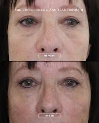 Mid-Cheek Hollow + Tear Trough Rejuvenation ✨️ Subtle volume. Visible  difference. This transformation was achieved with just 1ml of dermal filler  ➡️ restoring structure and softening tired under eyes. 🫠 Treatment: £250